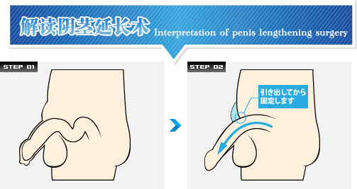 解读阴茎延长术